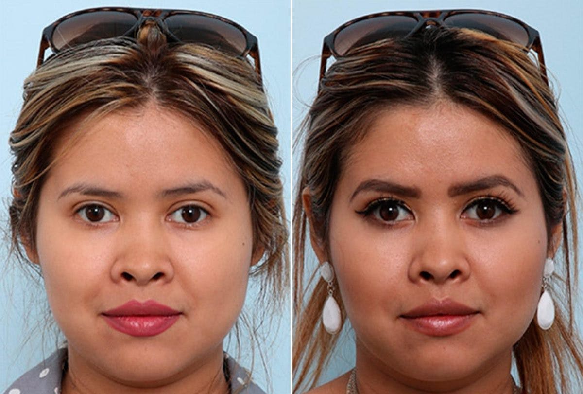 Buccal Fat Pad Removal Before & After Gallery - Patient 55104481 - Image 1