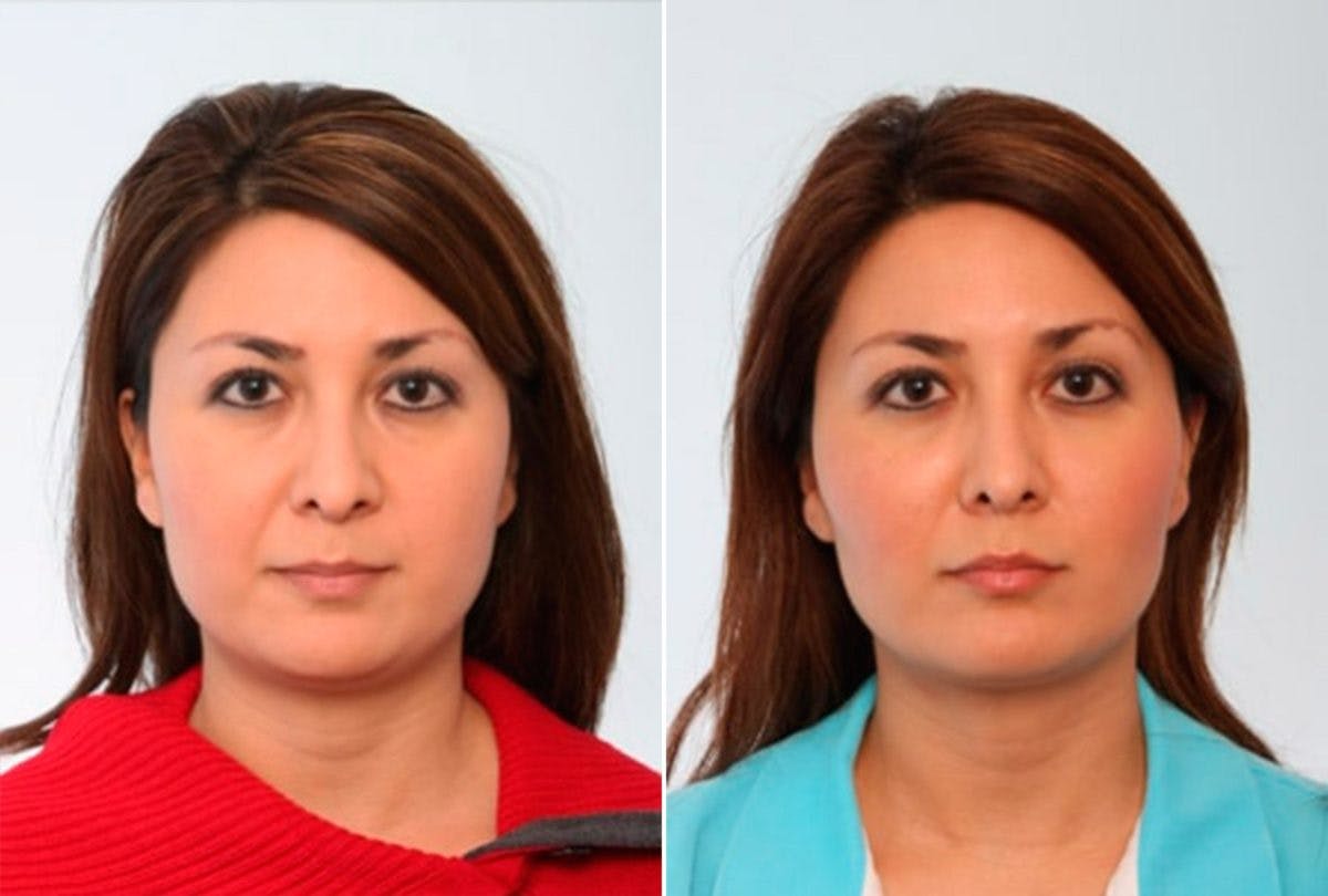 Buccal Fat Pad Removal Before & After Gallery - Patient 55104484 - Image 1