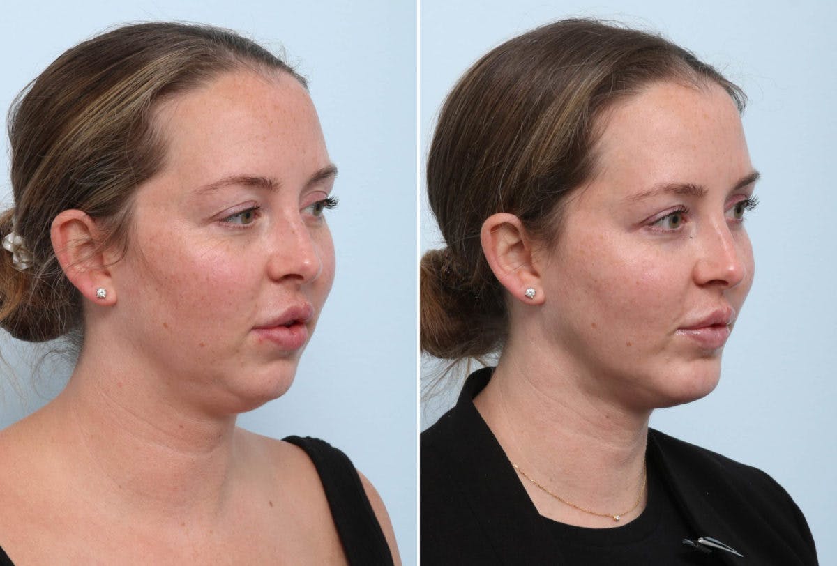 Chin Augmentation Before & After Gallery - Patient 55104485 - Image 1