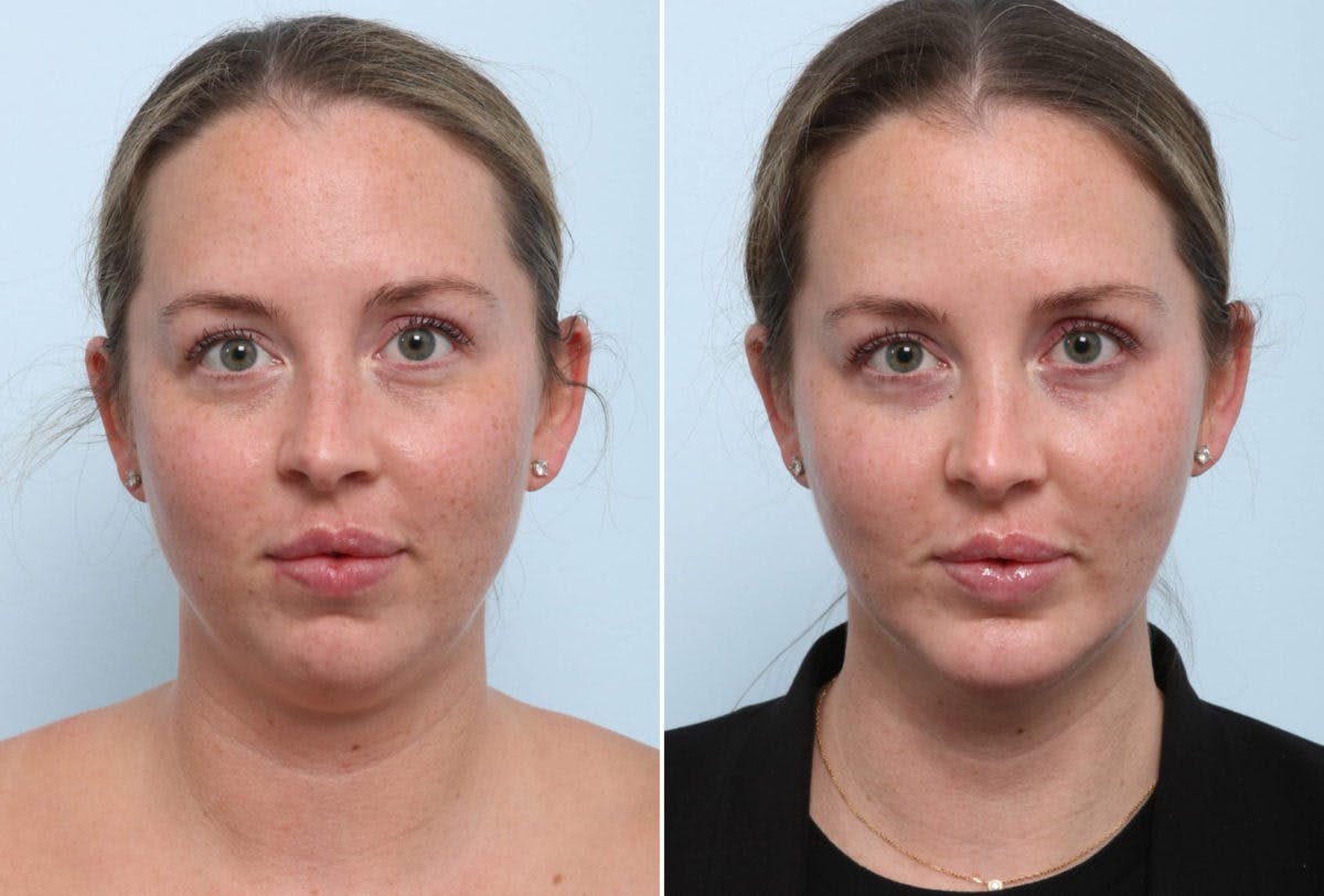 Chin Augmentation Before & After Gallery - Patient 55104485 - Image 3