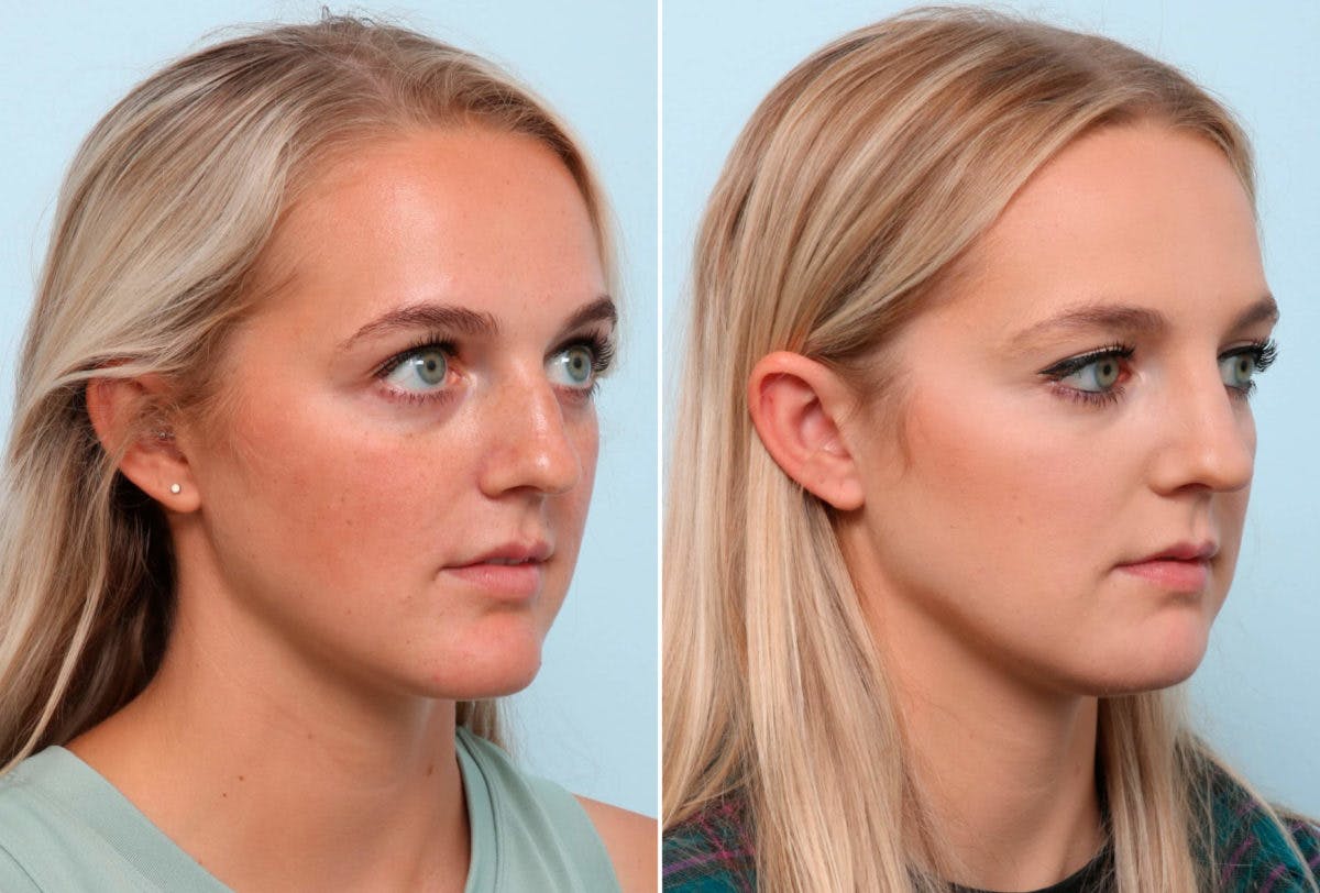 Chin Augmentation Before & After Photo - Patient 55104486 - Image 1