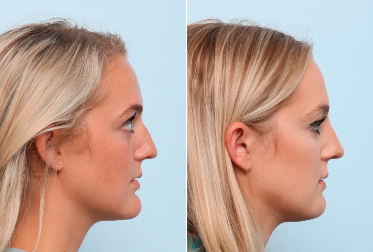 Chin Augmentation Before & After Photo - Patient 55104486 - Image 2