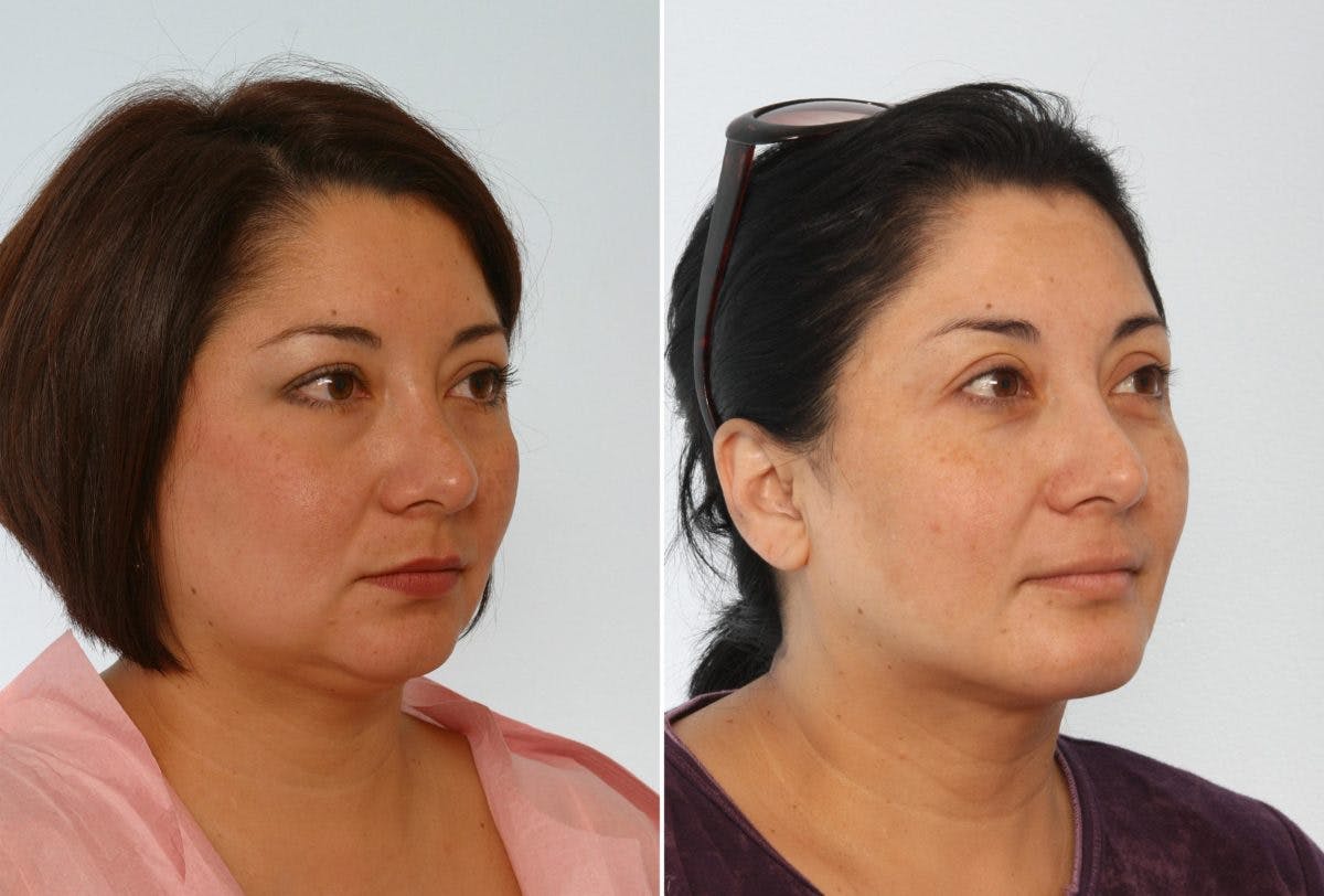 Chin Augmentation Before & After Gallery - Patient 55104489 - Image 1
