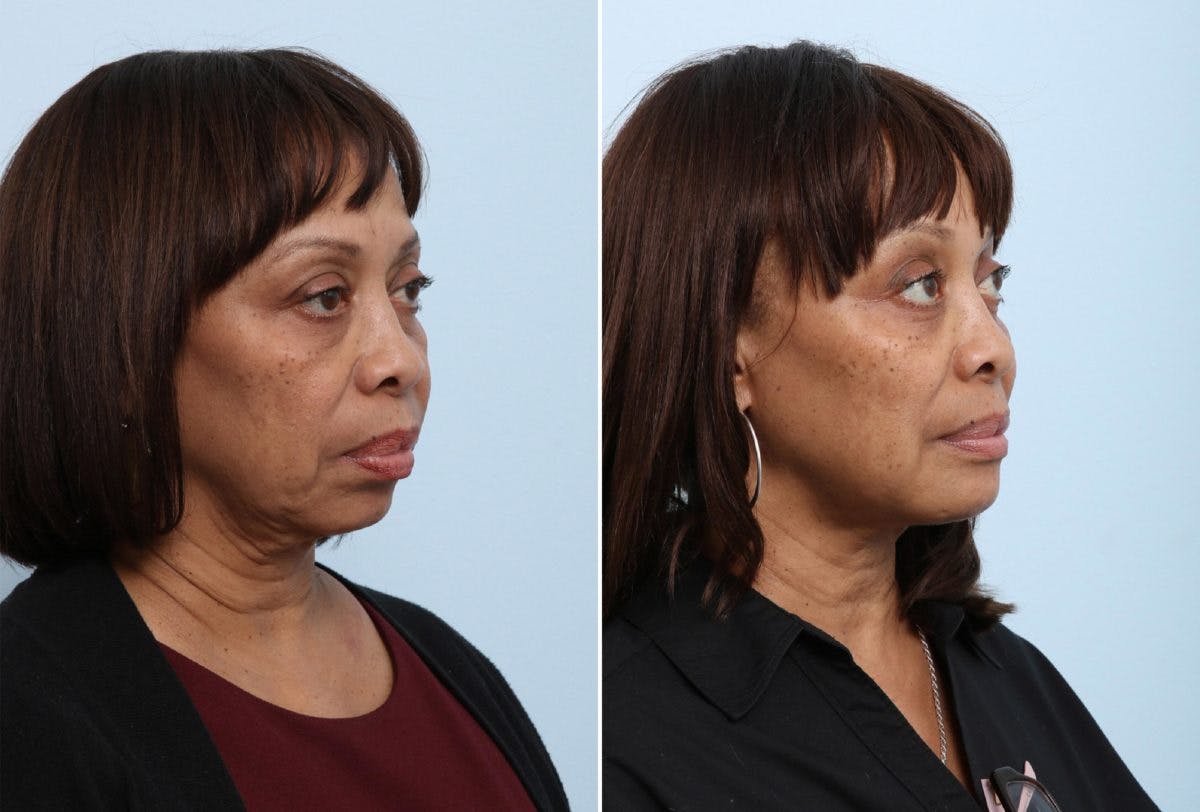 Chin Augmentation Before & After Gallery - Patient 55104490 - Image 1