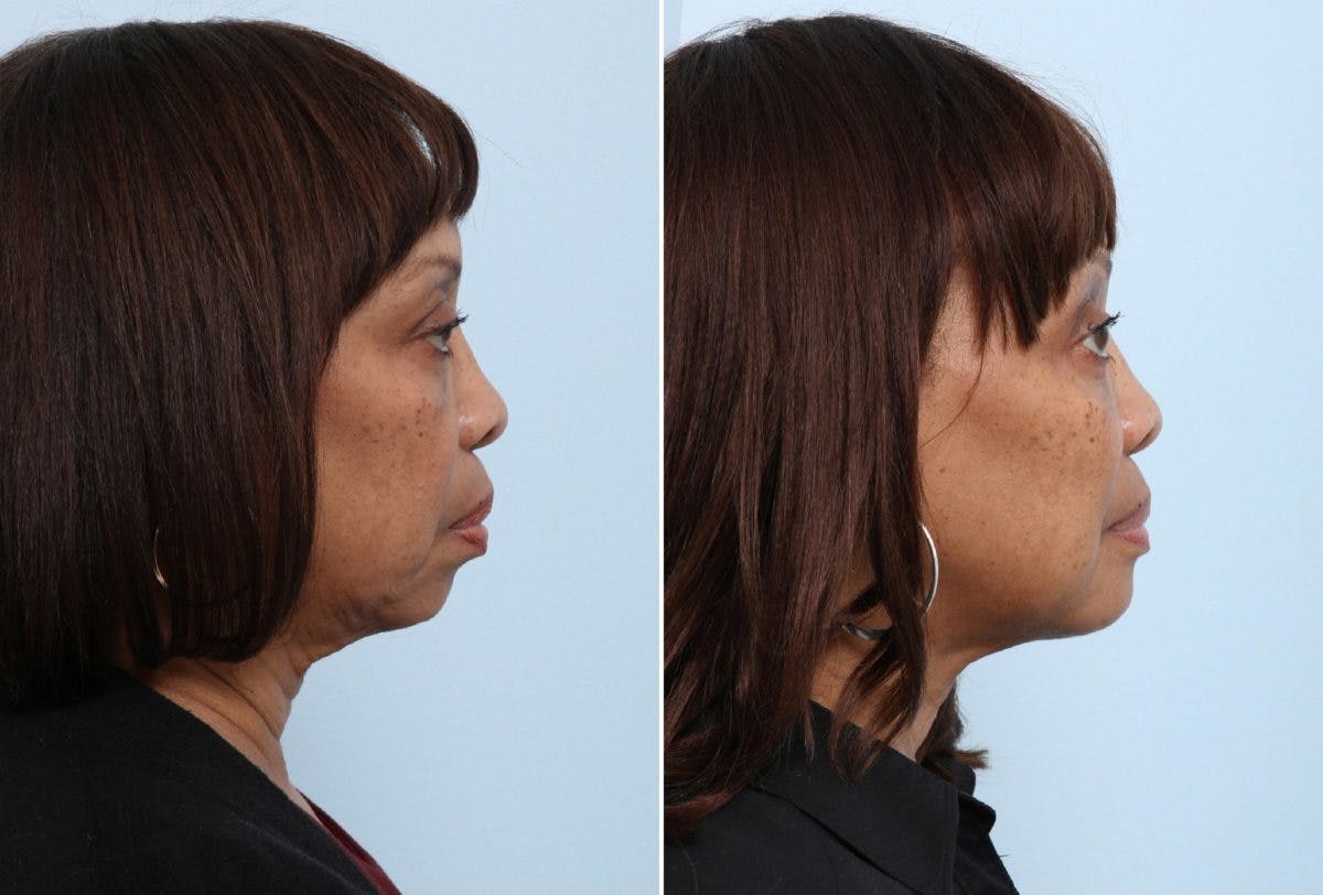 Chin Augmentation Before & After Gallery - Patient 55104490 - Image 2