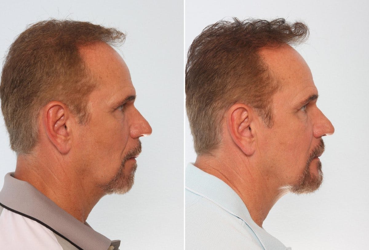 Chin Augmentation Before & After Gallery - Patient 55104491 - Image 2
