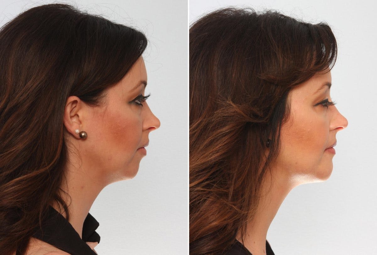Chin Augmentation Before & After Gallery - Patient 55104492 - Image 2