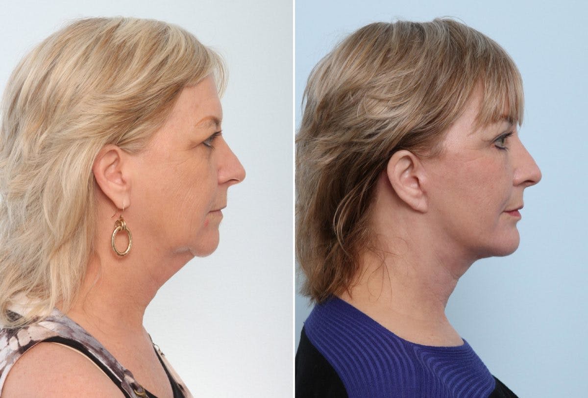 Chin Augmentation Before & After Gallery - Patient 55104493 - Image 2
