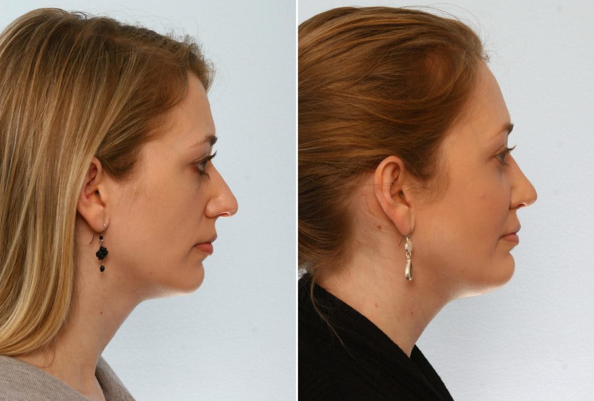 Chin Augmentation Before & After Gallery - Patient 55104494 - Image 2