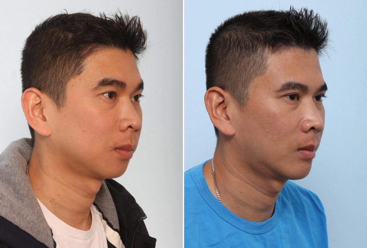 Chin Augmentation Before & After Gallery - Patient 55104497 - Image 1