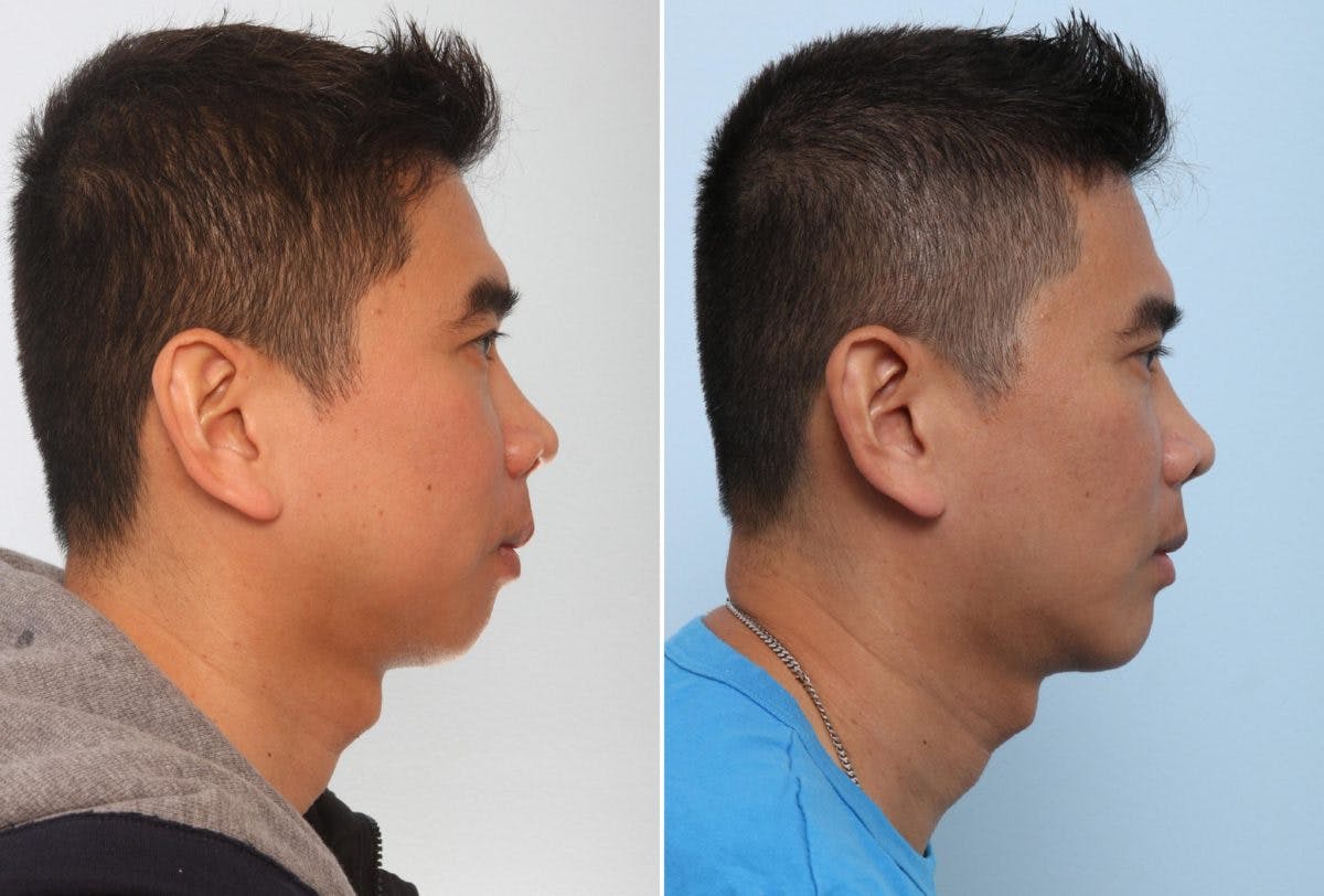 Chin Augmentation Before & After Gallery - Patient 55104497 - Image 2
