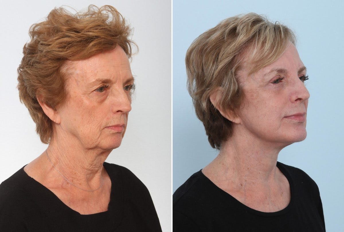 Chin Augmentation Before & After Photo - Patient 55104498 - Image 1