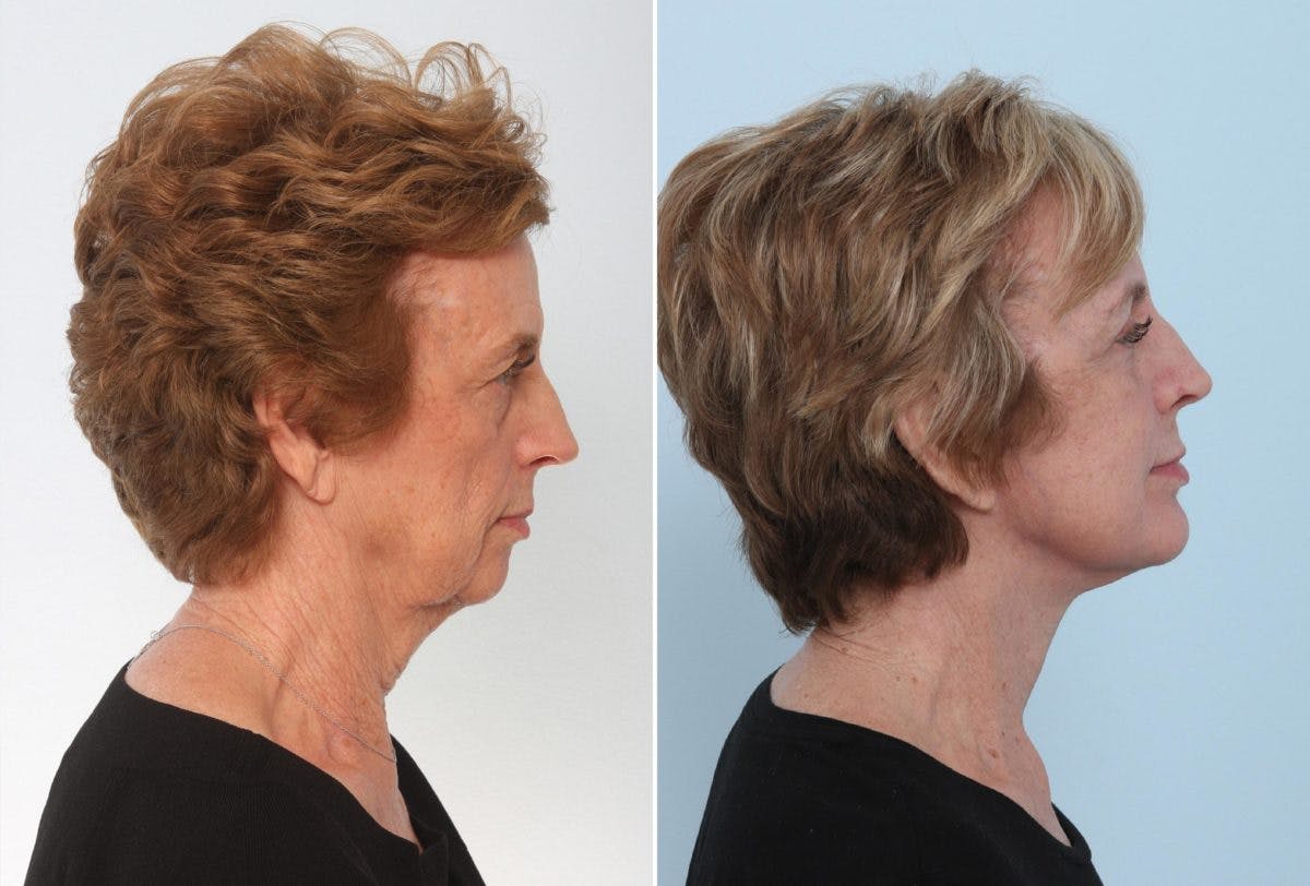 Chin Augmentation Before & After Photo - Patient 55104498 - Image 2