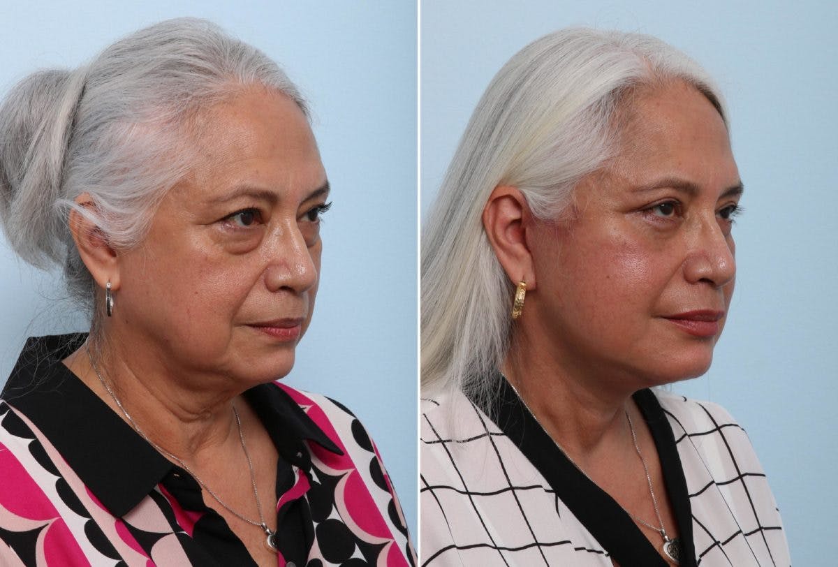 Chin Augmentation Before & After Gallery - Patient 55104499 - Image 1