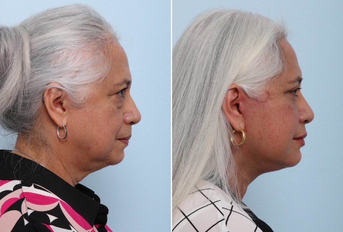 Chin Augmentation Before & After Gallery - Patient 55104499 - Image 2