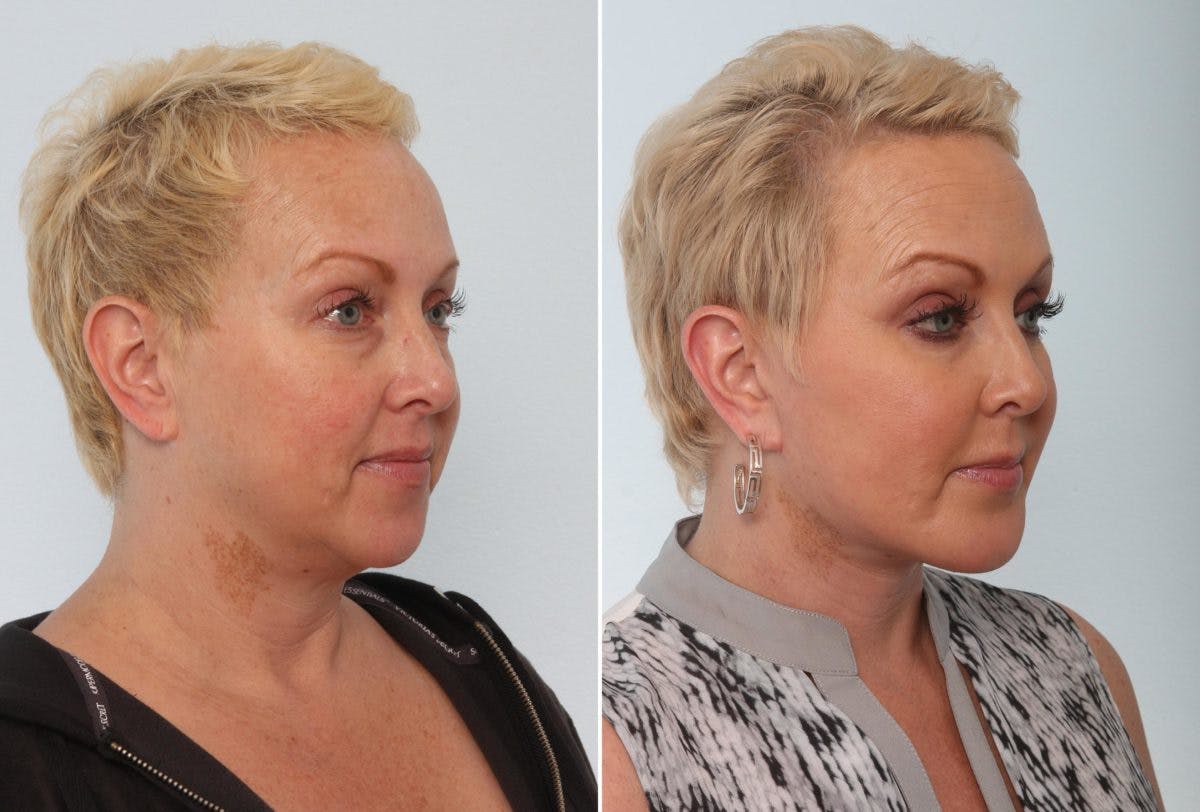 Chin Augmentation Before & After Gallery - Patient 55104500 - Image 1
