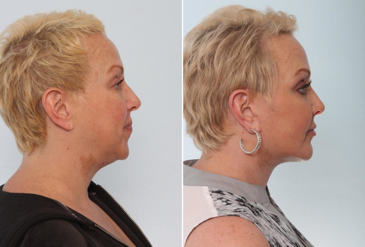 Chin Augmentation Before & After Gallery - Patient 55104500 - Image 2
