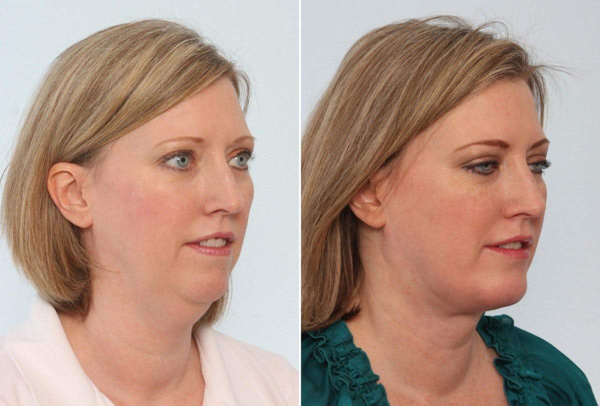 Chin Augmentation Before & After Gallery - Patient 55104501 - Image 1
