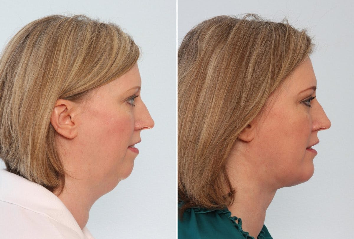 Chin Augmentation Before & After Gallery - Patient 55104501 - Image 2