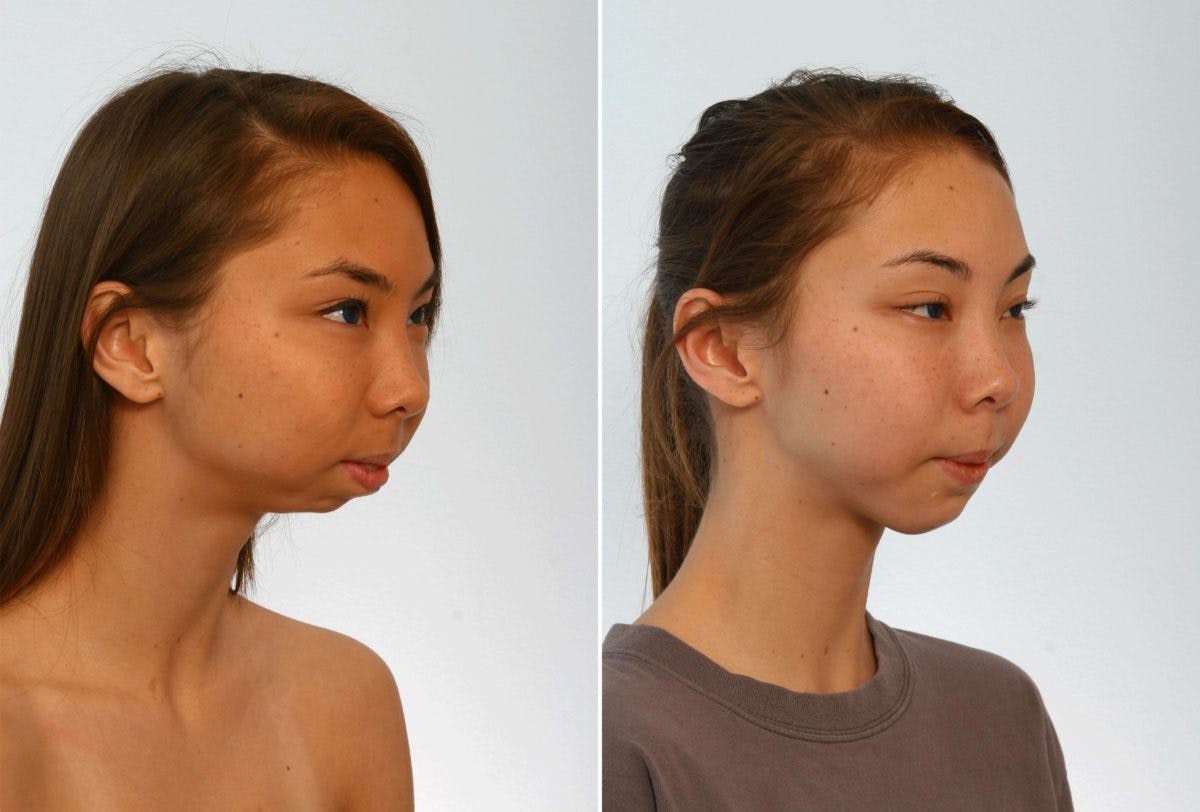 Chin Augmentation Before & After Gallery - Patient 55104502 - Image 1