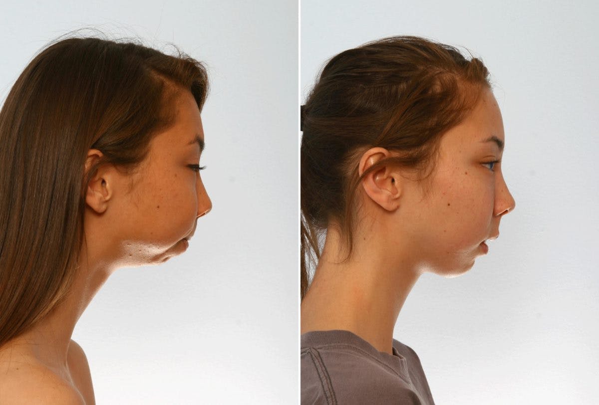 Chin Augmentation Before & After Gallery - Patient 55104502 - Image 2