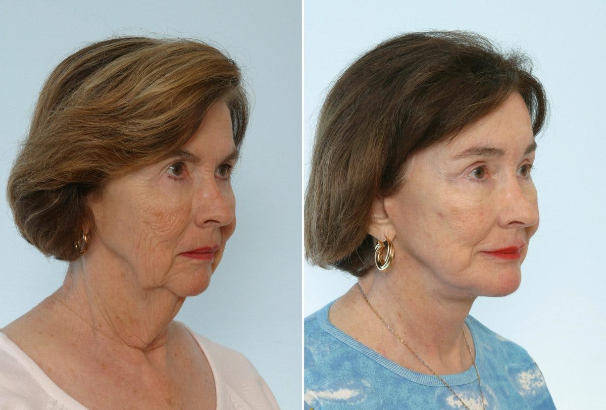 Chin Augmentation Before & After Gallery - Patient 55104503 - Image 1