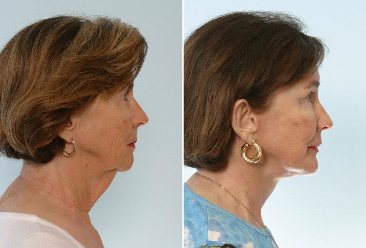 Chin Augmentation Before & After Gallery - Patient 55104503 - Image 2