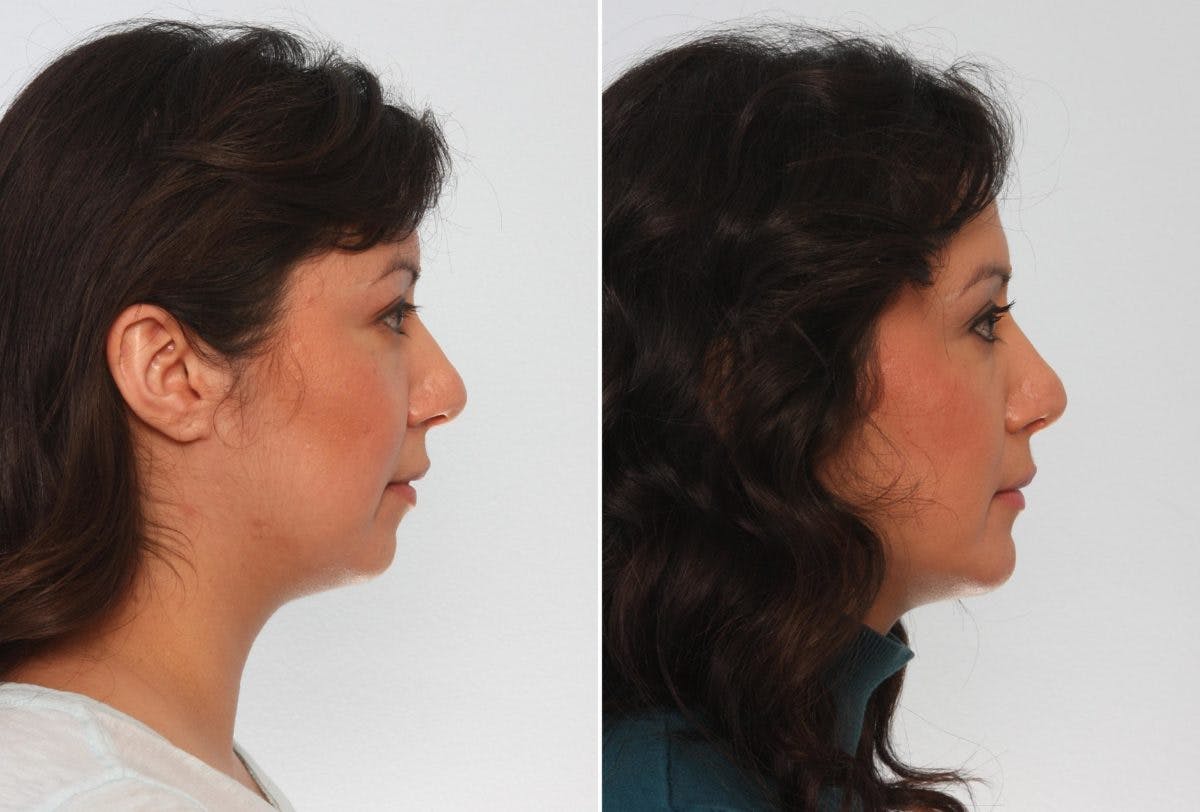 Chin Augmentation Before & After Gallery - Patient 55104504 - Image 2