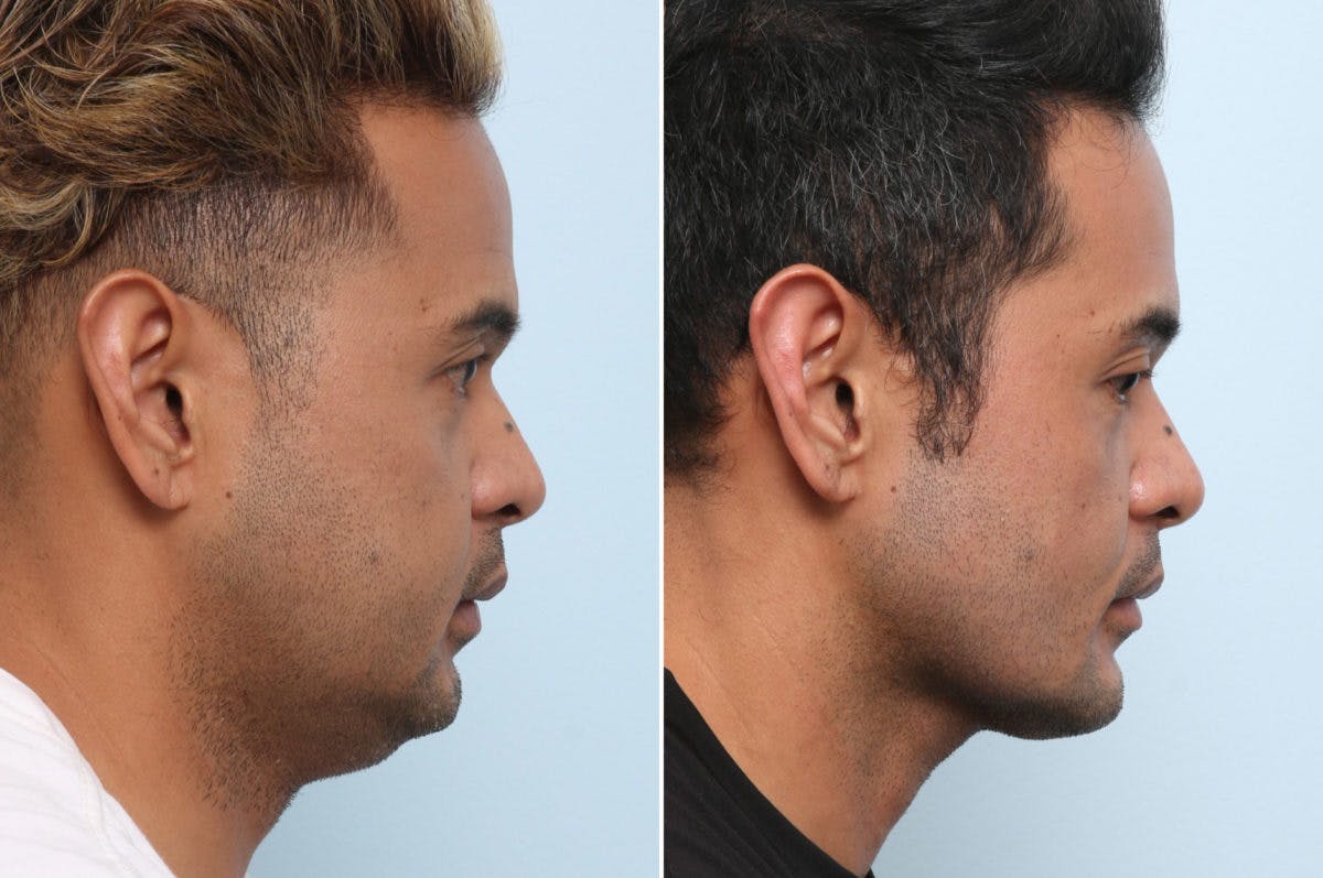 Chin Augmentation Before & After Gallery - Patient 55656638 - Image 3