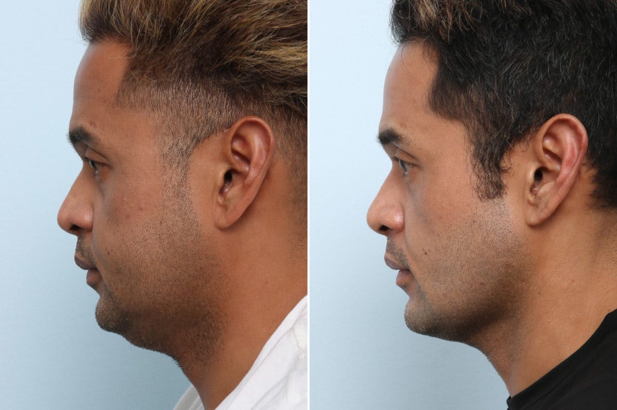 Chin Augmentation Before & After Gallery - Patient 55656638 - Image 5