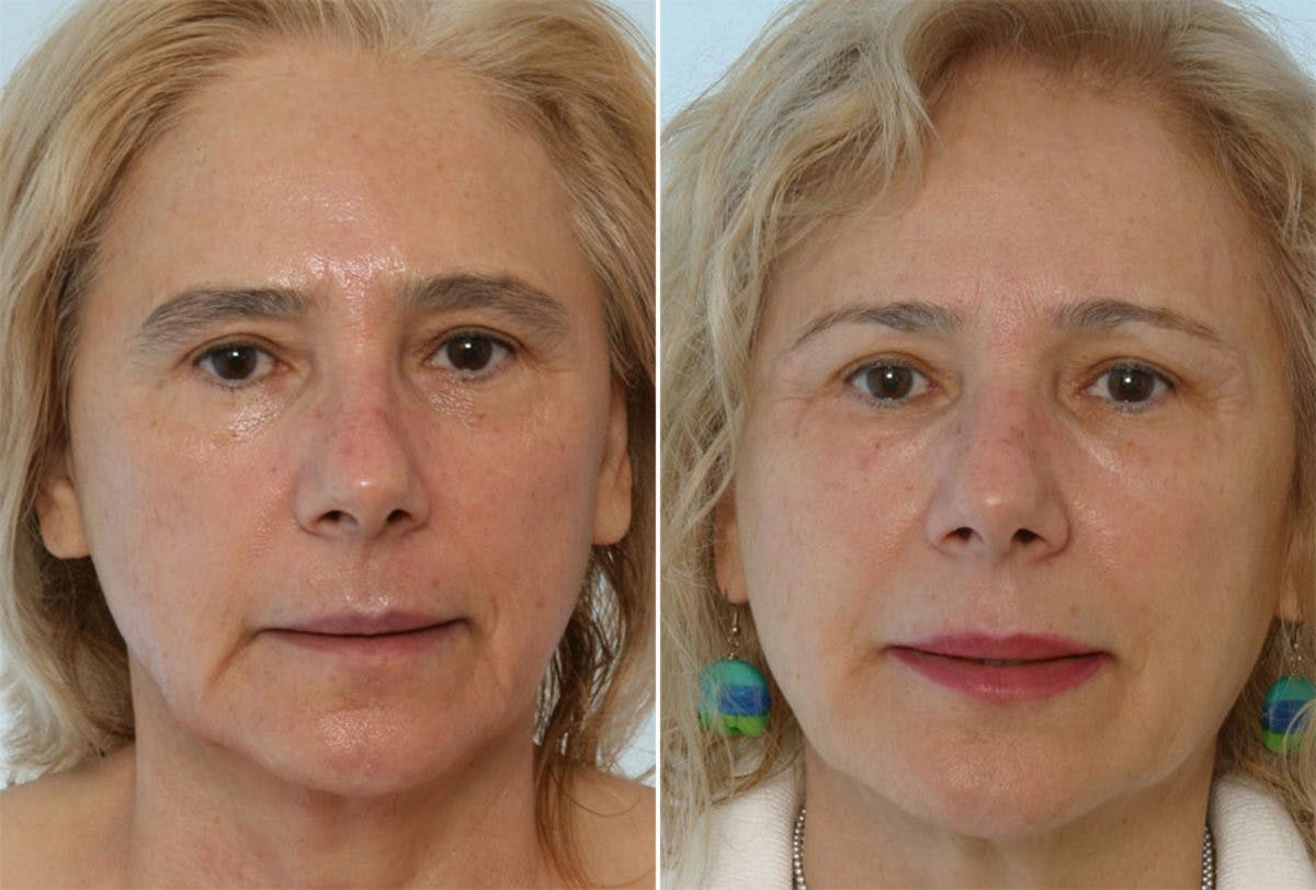 Combination Face Treatments Before & After Photo - Patient 55109386 - Image 1