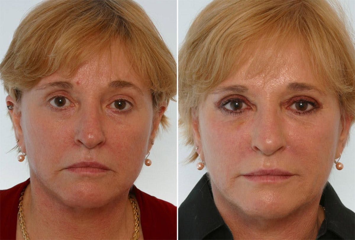 Combination Face Treatments Before & After Photo - Patient 55109388 - Image 1