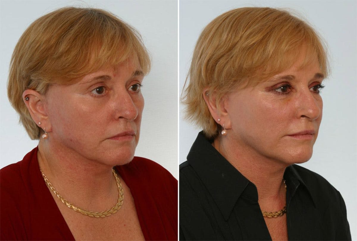 Combination Face Treatments Before & After Gallery - Patient 55109388 - Image 2