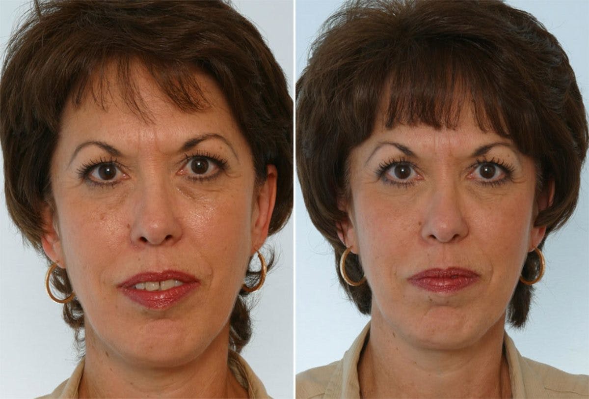 Combination Face Treatments Before & After Gallery - Patient 55109390 - Image 1