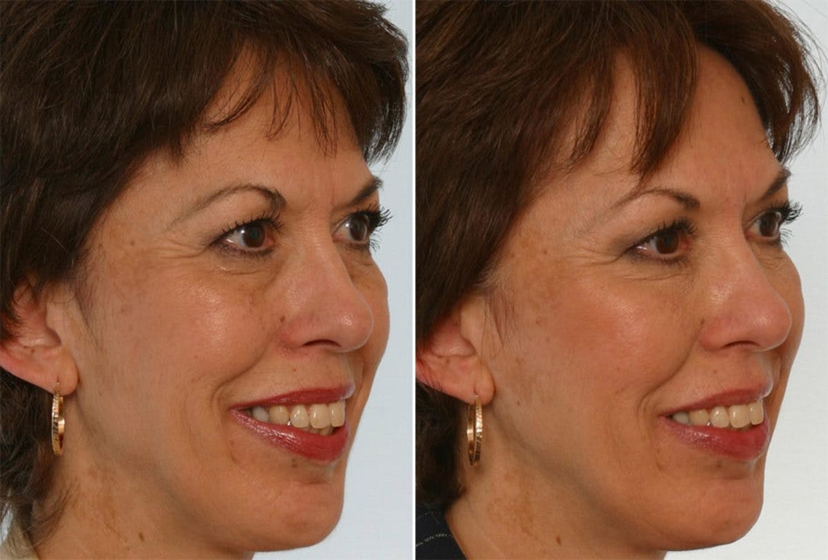 Combination Face Treatments Before & After Gallery - Patient 55109390 - Image 2