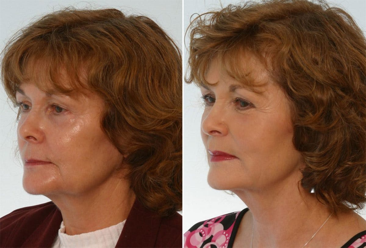 Combination Face Treatments Before & After Photo - Patient 55109391 - Image 2