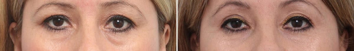 Blepharoplasty Before & After Gallery - Patient 55114271 - Image 1