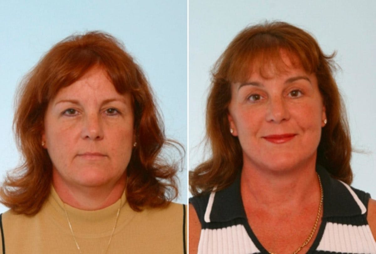 Blepharoplasty Before & After Gallery - Patient 55114281 - Image 1