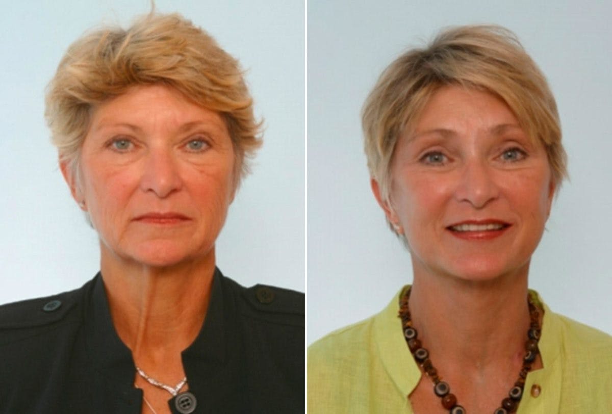 Blepharoplasty Before & After Photo - Patient 55114282 - Image 1