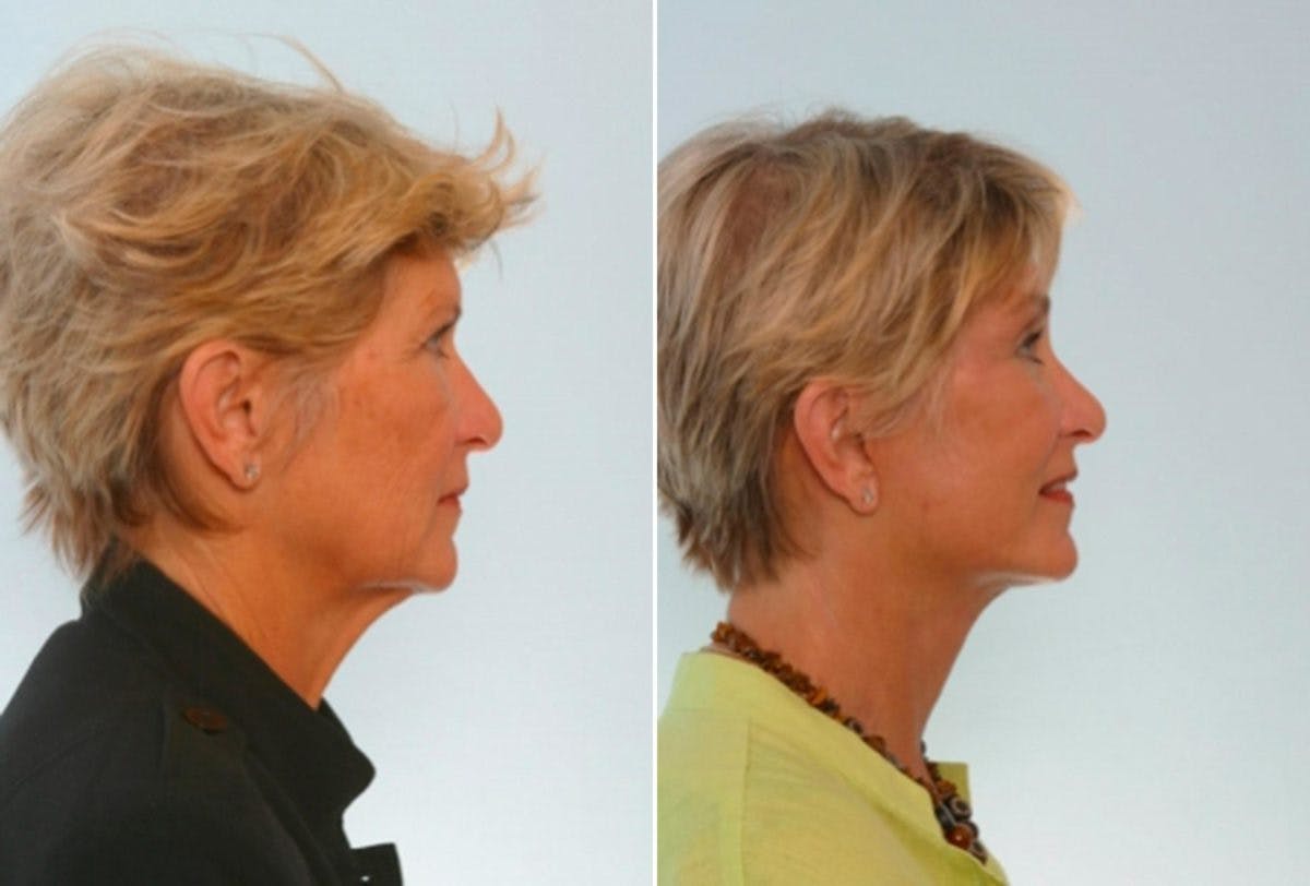Blepharoplasty Before & After Photo - Patient 55114282 - Image 3