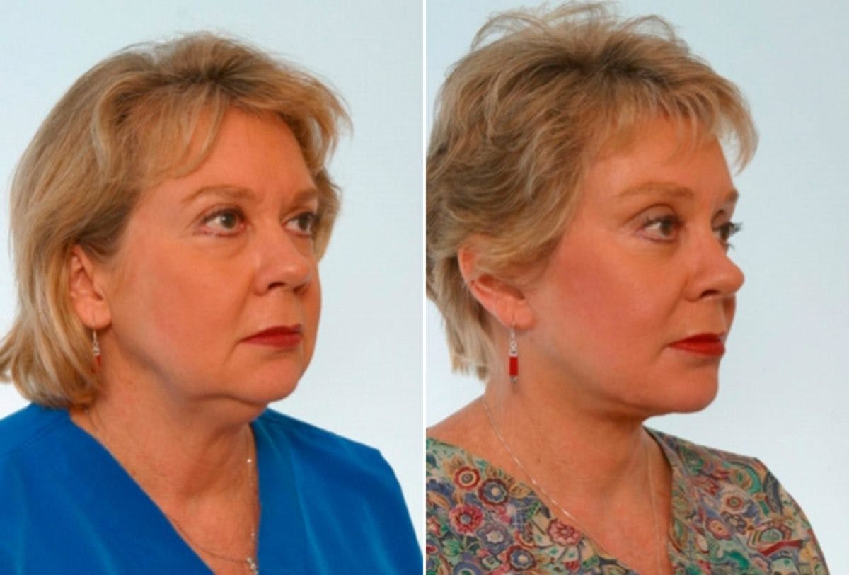 Blepharoplasty Before & After Gallery - Patient 55114283 - Image 2