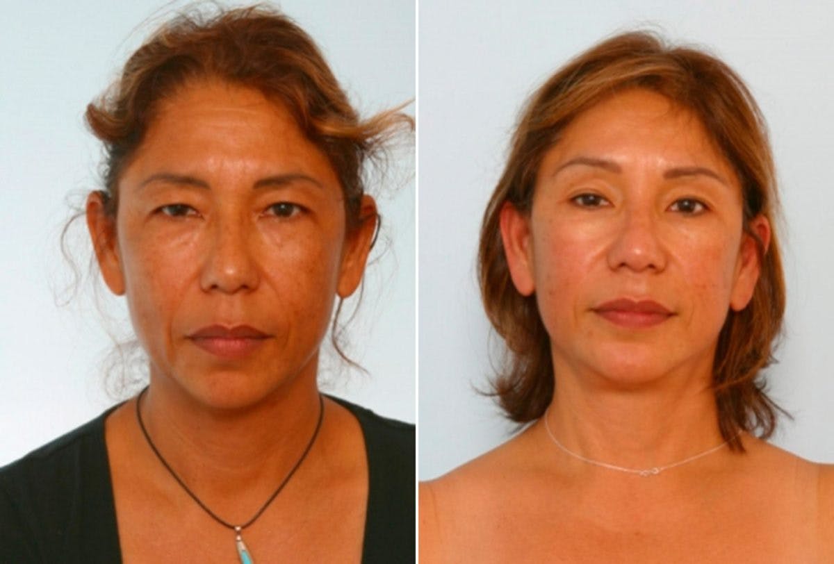 Blepharoplasty Before & After Photo - Patient 55114284 - Image 1