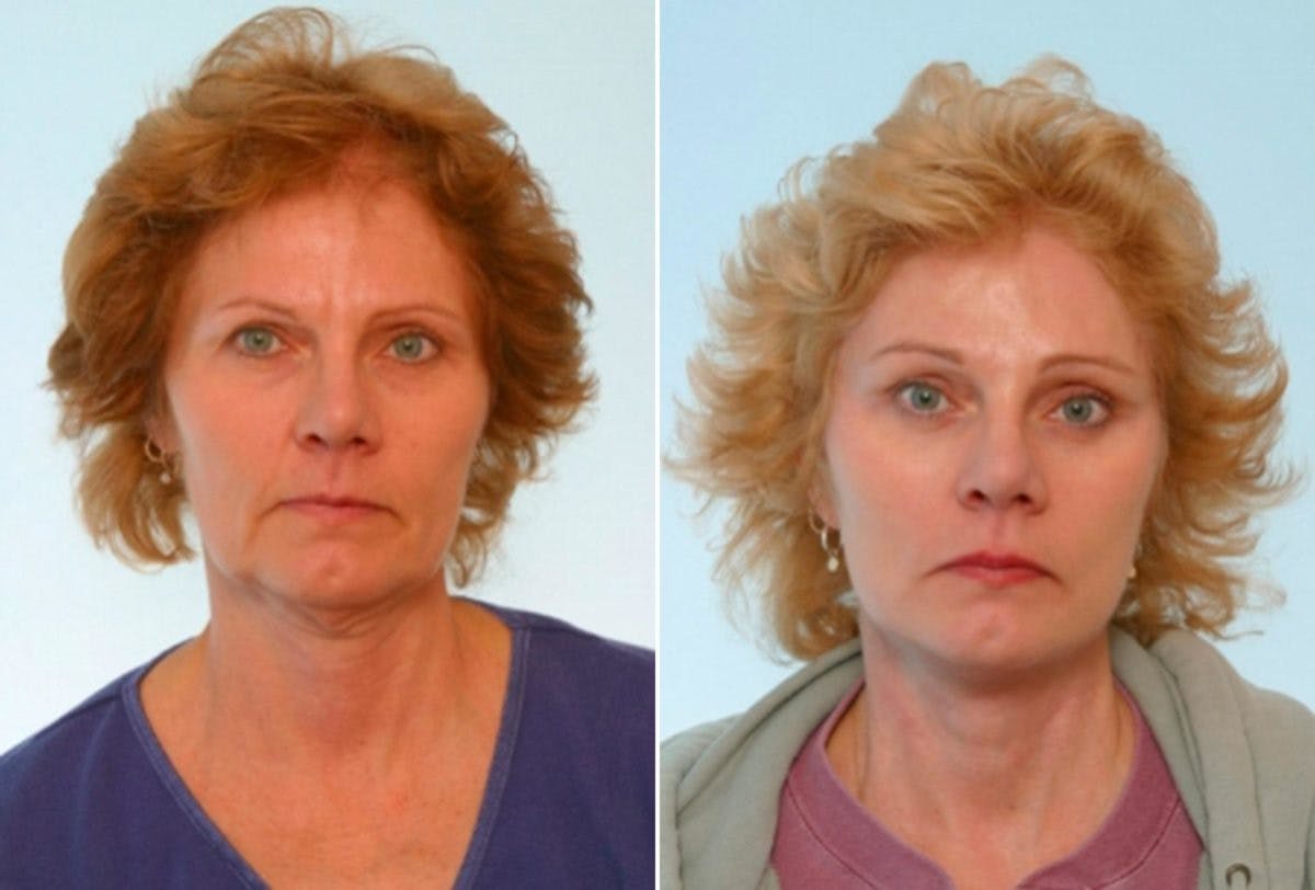 Blepharoplasty Before & After Photo - Patient 55114286 - Image 1
