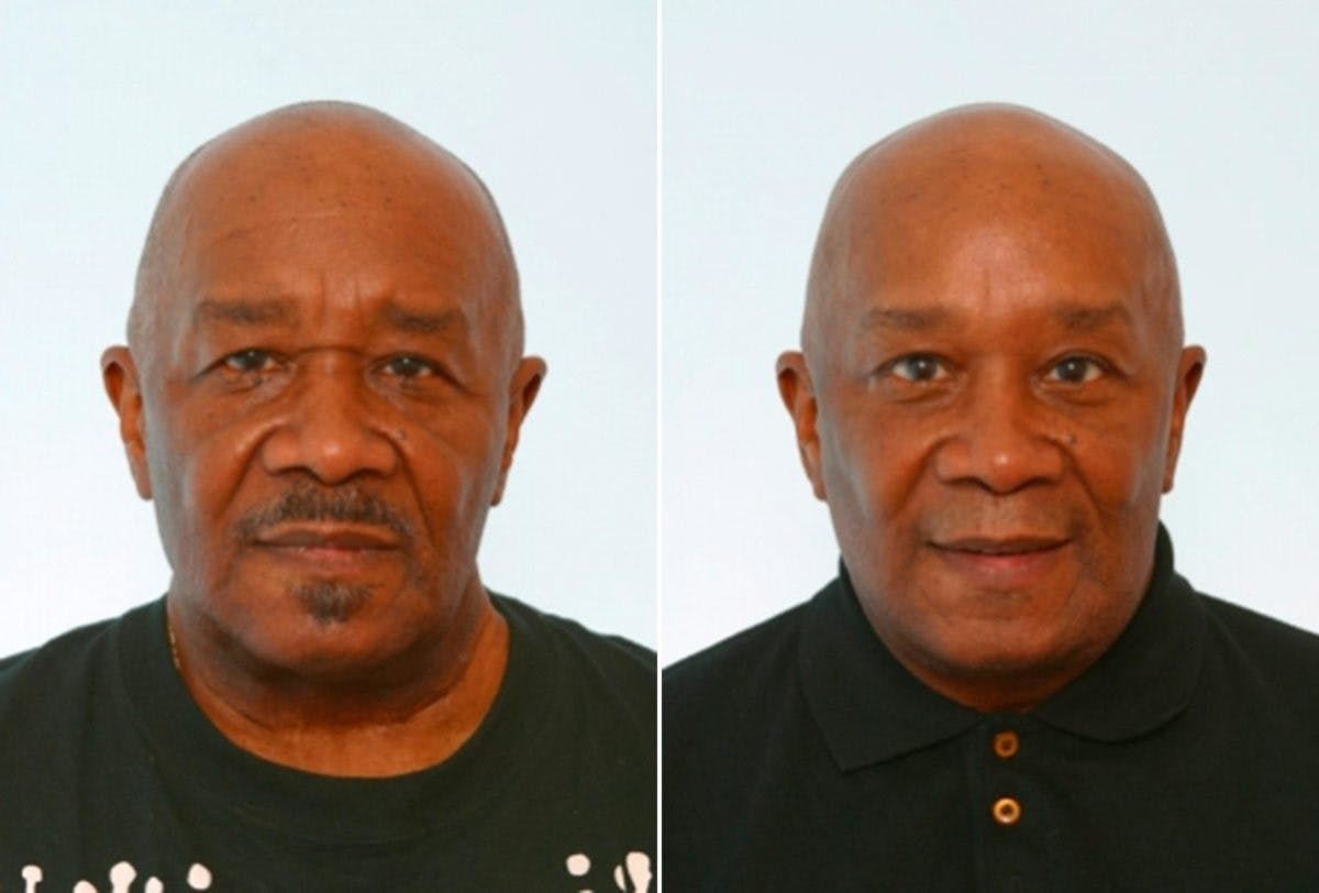 Blepharoplasty Before & After Gallery - Patient 55114287 - Image 1