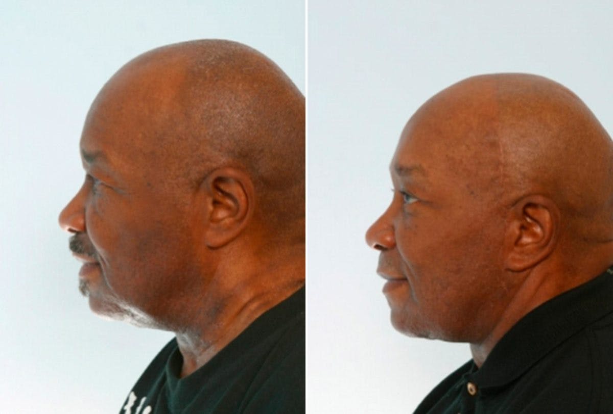Blepharoplasty Before & After Gallery - Patient 55114287 - Image 3