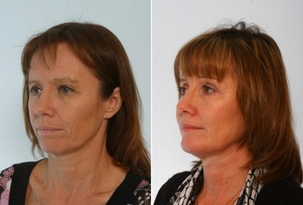 Blepharoplasty Before & After Photo - Patient 55114288 - Image 4