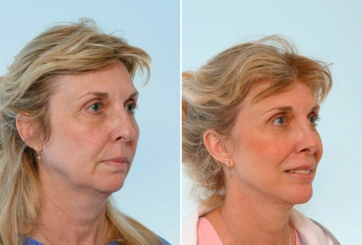 Blepharoplasty Before & After Gallery - Patient 55114289 - Image 2