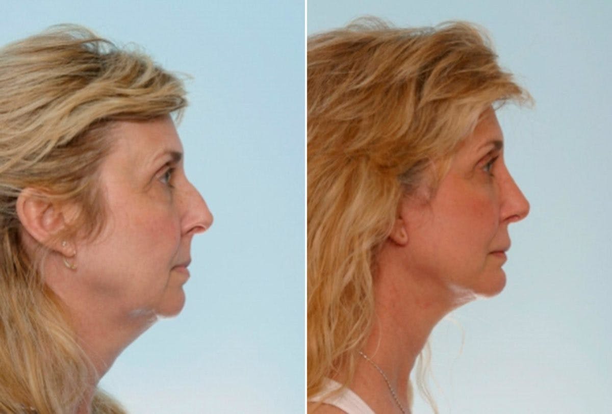 Blepharoplasty Before & After Gallery - Patient 55114289 - Image 3