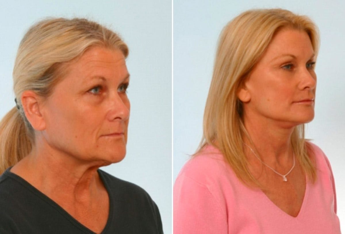 Blepharoplasty Before & After Gallery - Patient 55114290 - Image 2