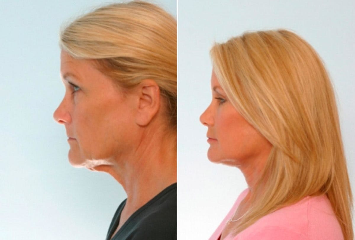 Blepharoplasty Before & After Gallery - Patient 55114290 - Image 3